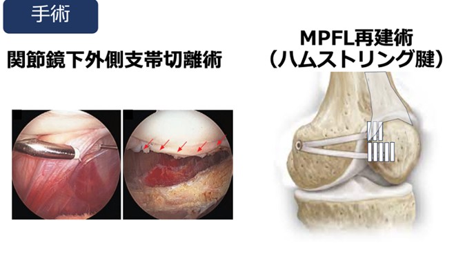 外側支帯の切離術およびMPFLの再建術