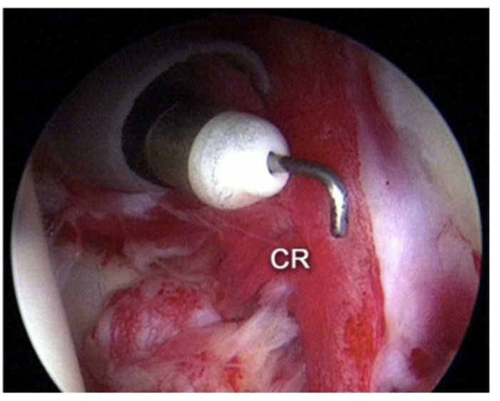 関節鏡下肩関節受動術