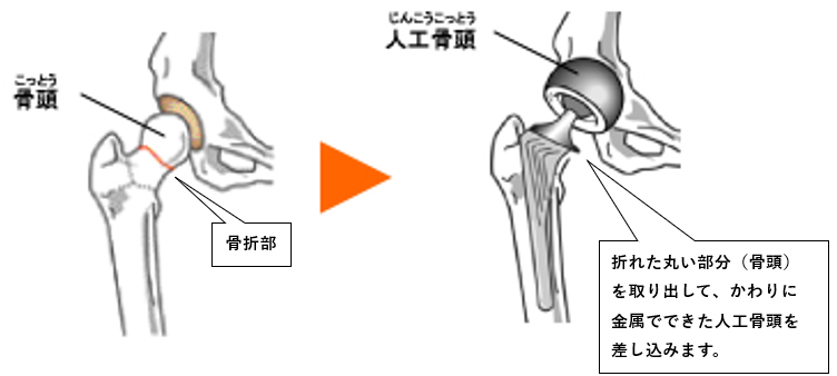 人工骨頭挿入術